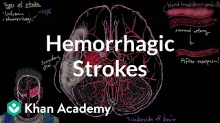 Hemorrhagic strokes | Circulatory System and Disease | NCLEX-RN | Khan Academy