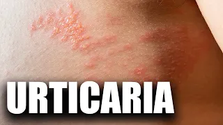 Urticaria: cauze și tratament