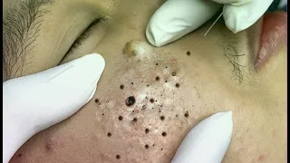 Super squeeze acne asmr #2