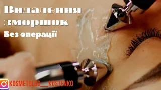 Видалення зморшок 🔥 краса 🔥 молодість 🔥 МІКРОСТРУМОВА ТЕРАПІЯ 🔥 DETOX 🔥