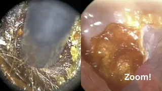 168 - Difficult Ear Wax Extraction using the WAXscope®️