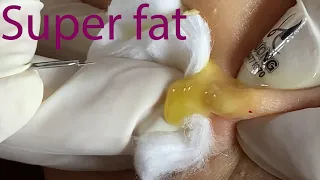 Acne Treatment Huong Da Nang#034  | 2023 | Loyal fans | Super fat