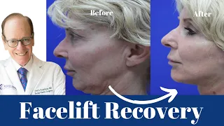 Facelift Recovery: A Comprehensive Guide | Dr. Joel Kopelman