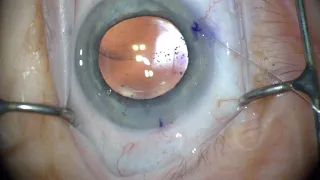 iTrack™ Procedural Steps: Conjunctival Blanching with iTrack™