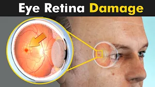 Retinitis Pigmentosa : Damage To Retina Of The Eye | Symptoms, Causes And Treatment