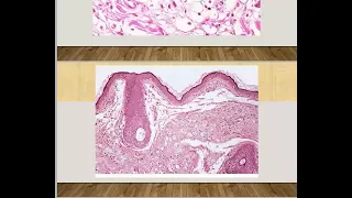 Lid Tumor "Clinical Part" | Ophthalmology Lecture for fellowship