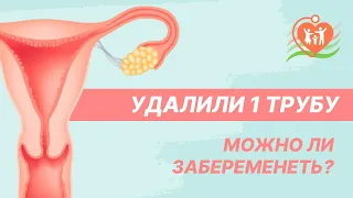 🤷 Удалили 1 трубу - можно ли забеременеть?