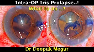 Intra-Operative Iris Prolapse- How to deal with it..?