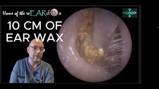 10 CM OF EAR WAX! Episode 119 #ear  #earwax #earwaxremoval #earcleaning #earwaxclinic