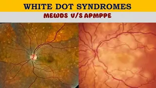 White Dot Syndromes | MEWDS V/s APMPPE