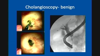 Primary Sclerosing Cholangitis: Update in Management