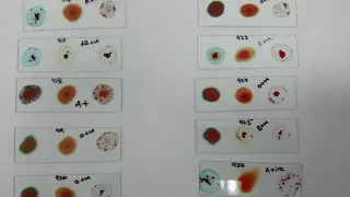 Blood grouping.For beginners.(In Urdu & Hindi)