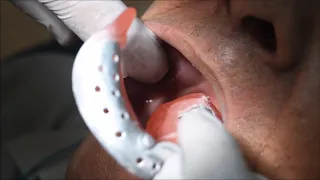 Clinical Complete PRS412 Mandibular  Primary impression