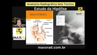 Anatomia Radiográfica da Sela Túrcica- Estudo da Hipófise