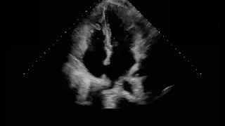 A4C LA pulmonary veins focus