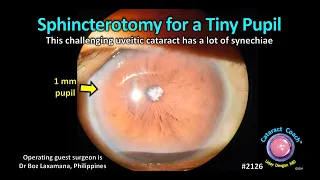 CataractCoach™ 2126: sphincterotomy for a tiny pupil in a uveitic cataract