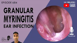 684 - Granular Myringitis Ear Infection