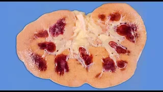 A Boy Ate 25 Laxative Brownies In 1 Hour. This Is What Happened To His Kidneys.