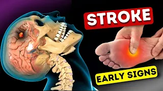 9 Warning Signs of Stroke One Month Before - Shocking Symptoms Revealed!