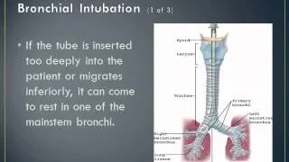 Endotracheal Intubation