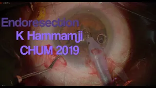 Choroidal Melanoma Endoresection for Toxic Tumor Syndrome  HD 720p