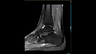 What does an Achilles tendon tear look like on MRI?