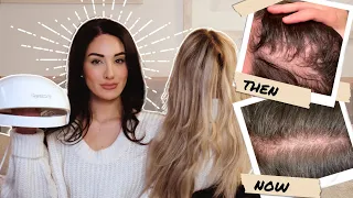 How I Reversed my Thinning Hair