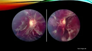 Ophthalmic Photography and Angiography Part 3: Choroidal Metastasis, Hemangioma and Osteoma