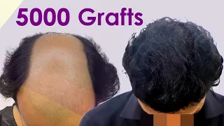 Grade 6 Baldness Solved: 5000 Graft Hair Transplant Makes a Difference (Bangalore)