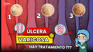 Úlcera varicosa : Cómo se forma y su tratamiento  🤔👨‍⚕️