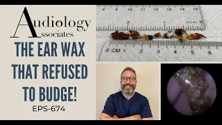 THE EAR WAX THAT REFUSED TO BUDGE - EP674