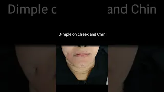 Dimple Creation Surgery #dimple #cheekdimples #dimples #chindimple #cosmetics #cosmeticsurgery