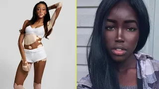 8 Charming People You’ve Never Seen Until Now with unique skin color