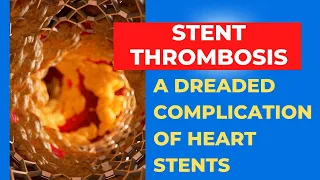 Stent Thrombosis: An important complication after heart stents. Part 1.