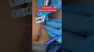 Tratamiento de cicatriz queloide después de una cesárea