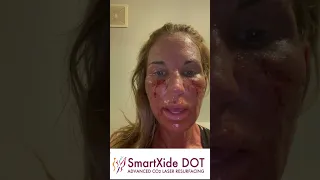 SmartXIDE DOT CO2 Laser Skin Resurfacing Day 2.2 Actual Patient Live Video Journal RealSelfie Vi...