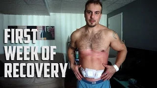 Hernia Surgery Recovery First Week - What to expect