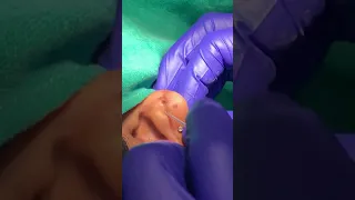 Ear piercing - novel simple n sterile technique