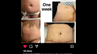 My Tummy Tuck Journey by Sarah