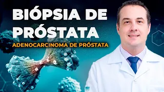 BIÓPSIA da PRÓSTATA, RESULTADO ADENOCARCINOMA - Dr. André Matos Urologista