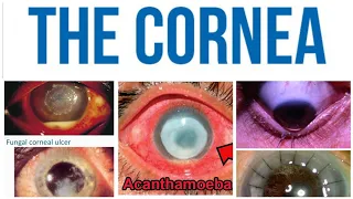 Cornea 7 Major Topic: Herpes Simplex Keratitis