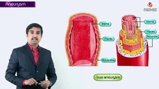 Aneurysms - Definition & Types of aneursym ( true , false , fusiform  and saccular )