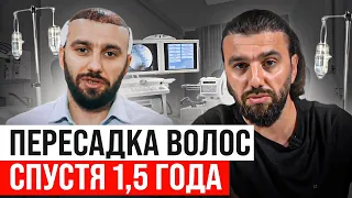 Как изменилась моя жизнь после пересадки волос // Пересадка волос в Турции спустя 1,5 года