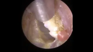 817 - Grade III Keratosis Obturans & Tympanosclerosis Ear Wax Removal