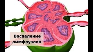 Воспаление лимфоузлов (лимфаденит) – симптомы, причины, осложнения и что делать