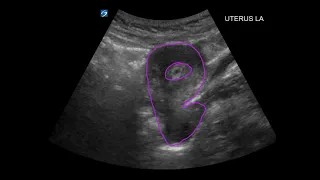 POCUS: 1st Trimester Pregnancy Case 1