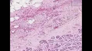 Histopathology Prostate --Adenocarcinoma (Gleason grade 3)