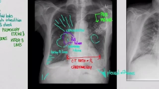 CXR Congestive Heart Failure (CHF)