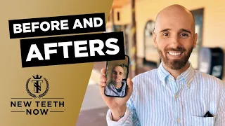 Amazing Dental Implant Before and Afters | New Teeth Now