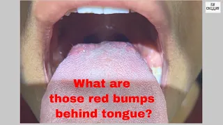 What are Red bumps behind Tongue ?  Taste Buds- How to keep them clean and healthy?